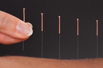 acupuncture